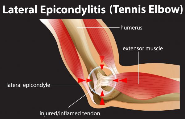 אז מה זה מרפק טניס (tennis elbow)